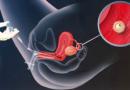 Искусственное внутриматочное оплодотворение спермой мужа или донора - показания, подготовка к операции и цена